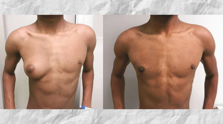 best gynecomastia surgeon in Hyderabad, best hospital for gynecomastia surgery in Hyderabad.